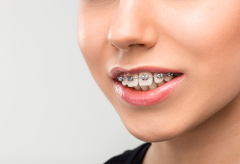 Best Teeth Alignment Treatment in Otteri Chennai