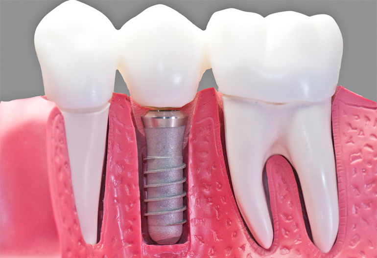 Best Implant Dentist in Ayanavaram Chennai