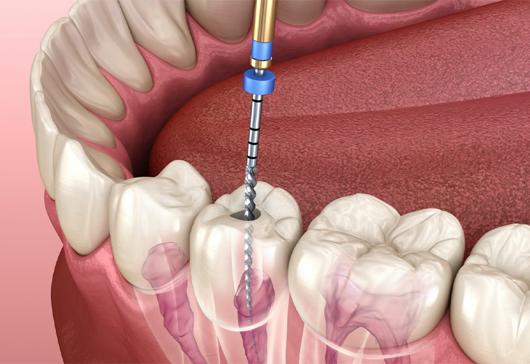 Root Canal Treatment Cost in ayanavaram chennai